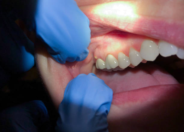 Best Emergency Tooth Extraction in Wesley Chapel, NC