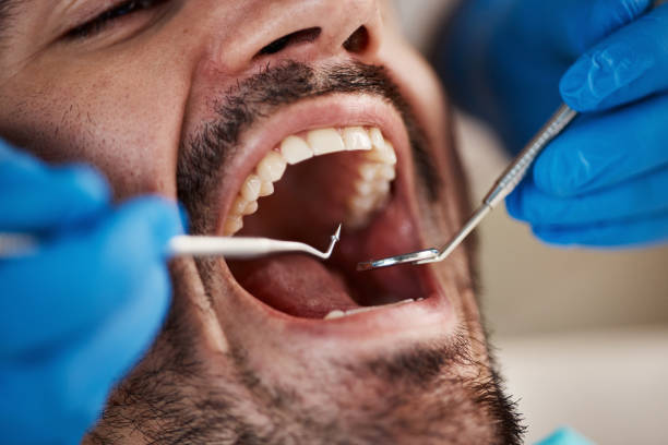 Best Emergency Wisdom Teeth Removal in Wesley Chapel, NC